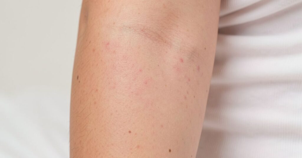 Coconut Oil for Stretch Marks