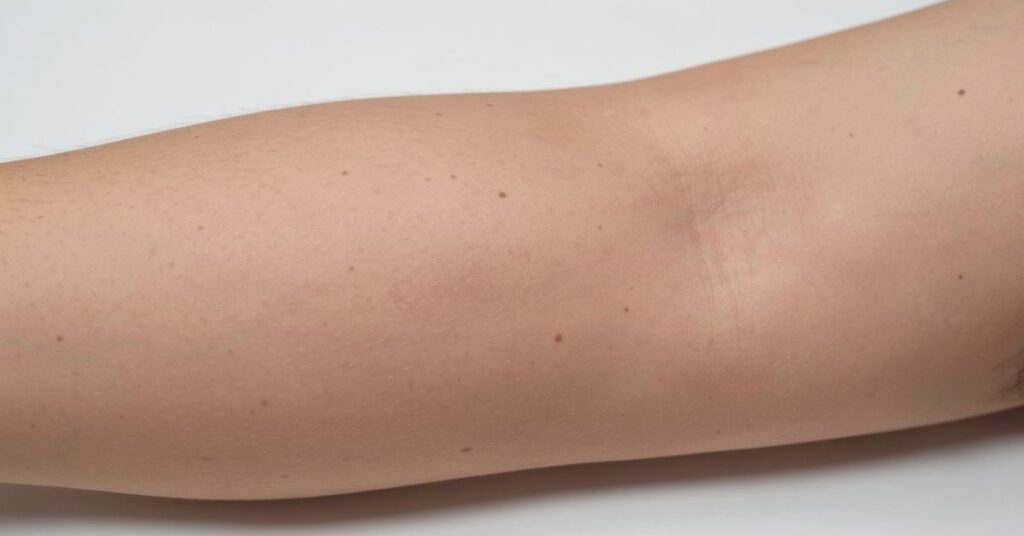 Coconut Oil for Stretch Marks