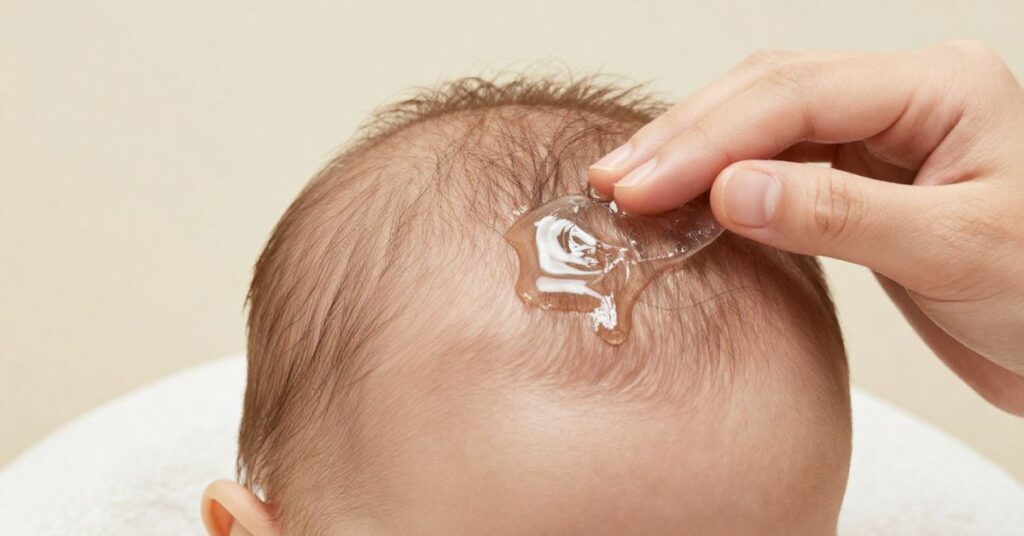 Coconut Oil for Cradle Cap