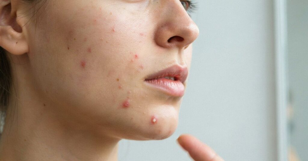 Essential Oils for Pimples