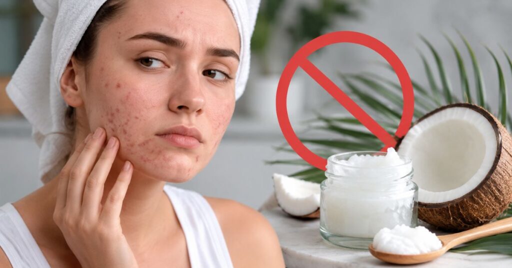 Coconut Oil for Acne