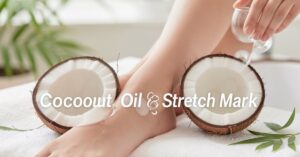 Coconut Oil for Stretch Marks