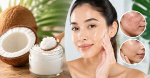 Is Coconut Oil Comedogenic