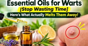 Essential Oils for Warts